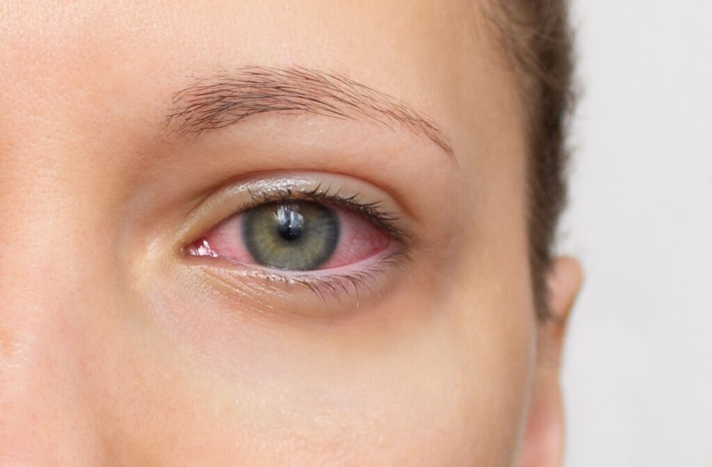 A close-up of the red irritated eyes of someone suffering from dry eye disease